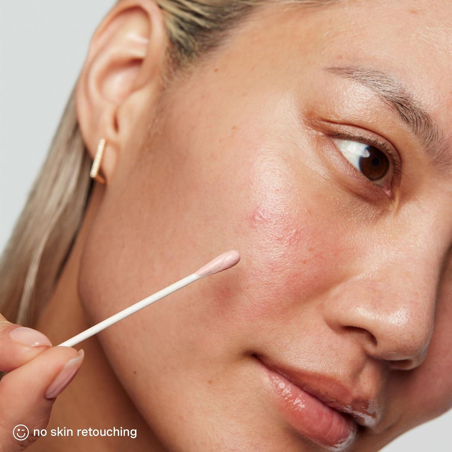 We Uncovered Kate's Secret: Zapping Zits in a Flash