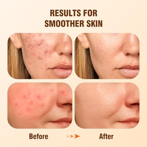 Salicylic Acid Serum 2%: Clear Pores, Control Oil, Smooth Skin Texture - Image 2