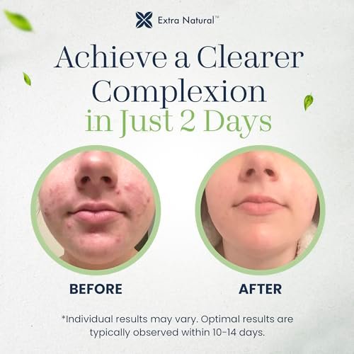 Here's a revised title:
Natural Acne Treatment Cream | Maximum Strength Clear Skin Formula - Image 7