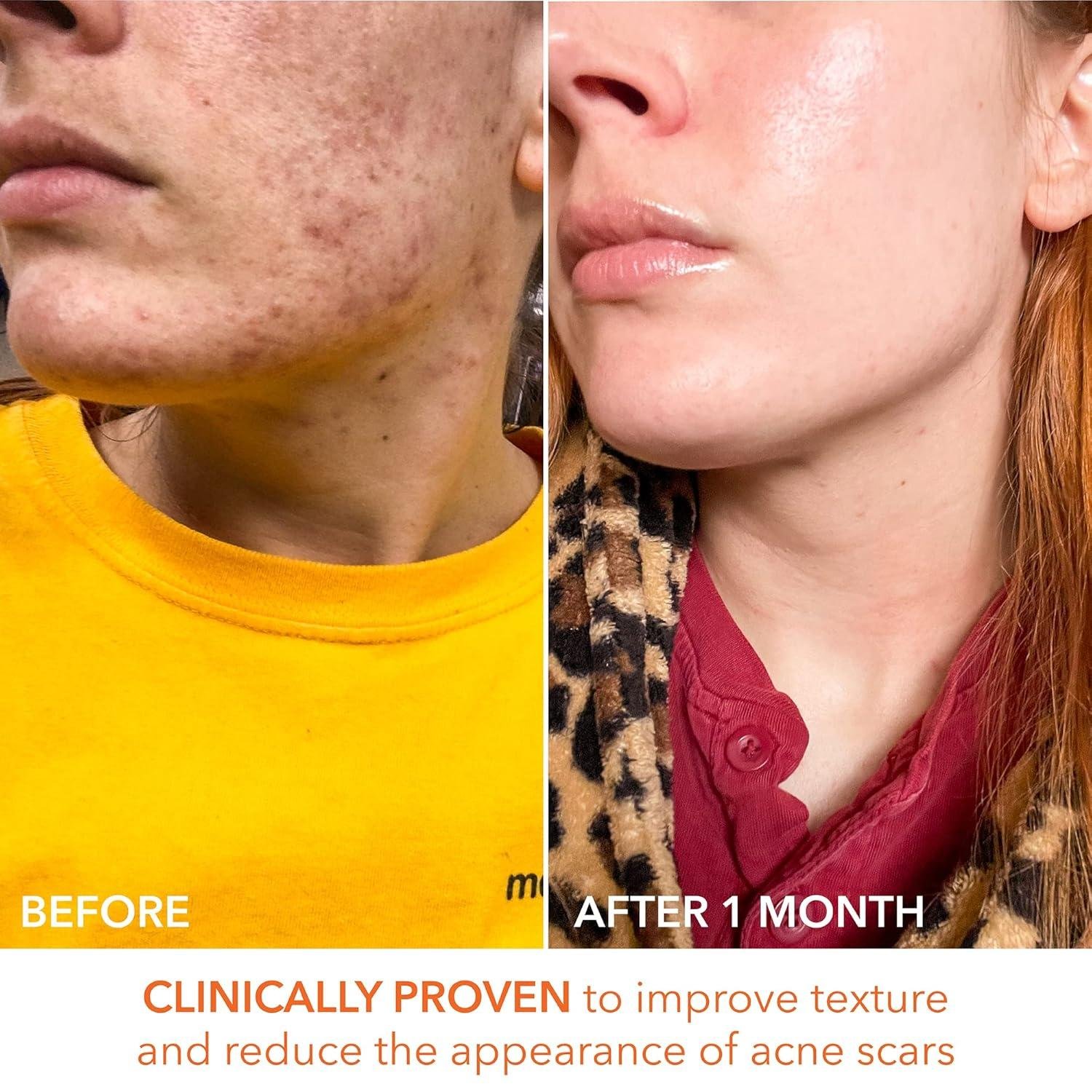 Dr.Dennis Gross​ Daily ⁤peel Review: Worth It for Texture?