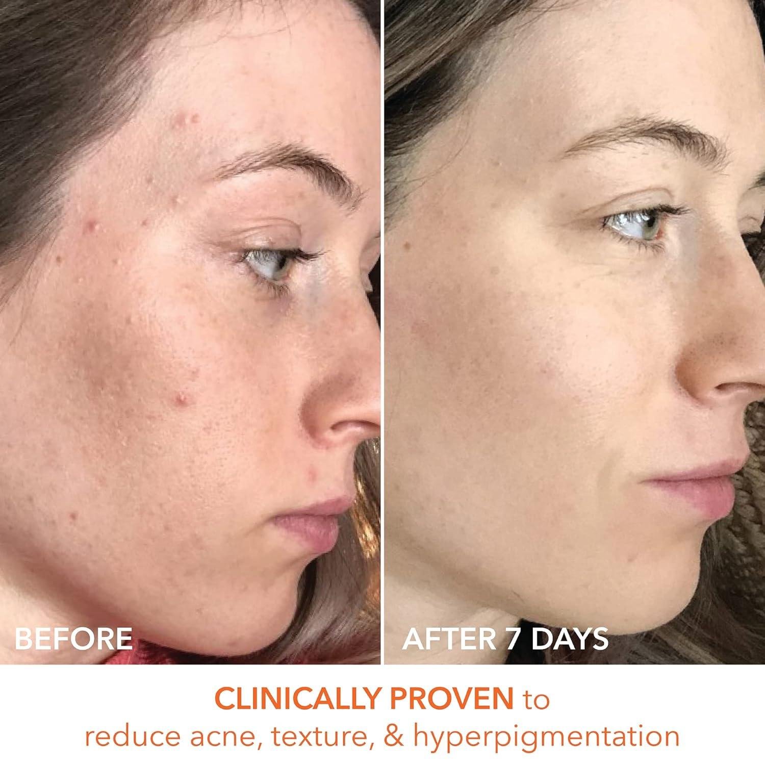 Dr. Dennis Gross Daily Peel Review: Worth It for Texture?