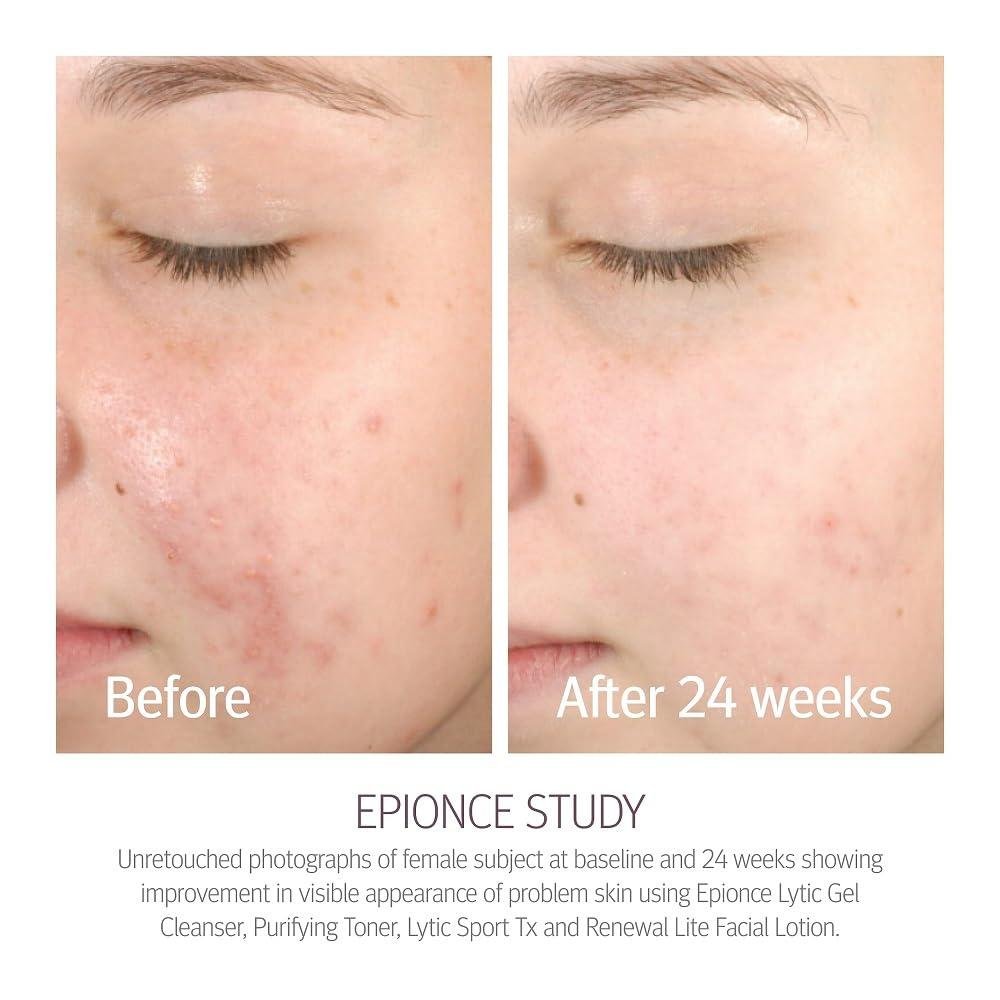 Epionce renewal Lite Review: Best for Oily Skin?