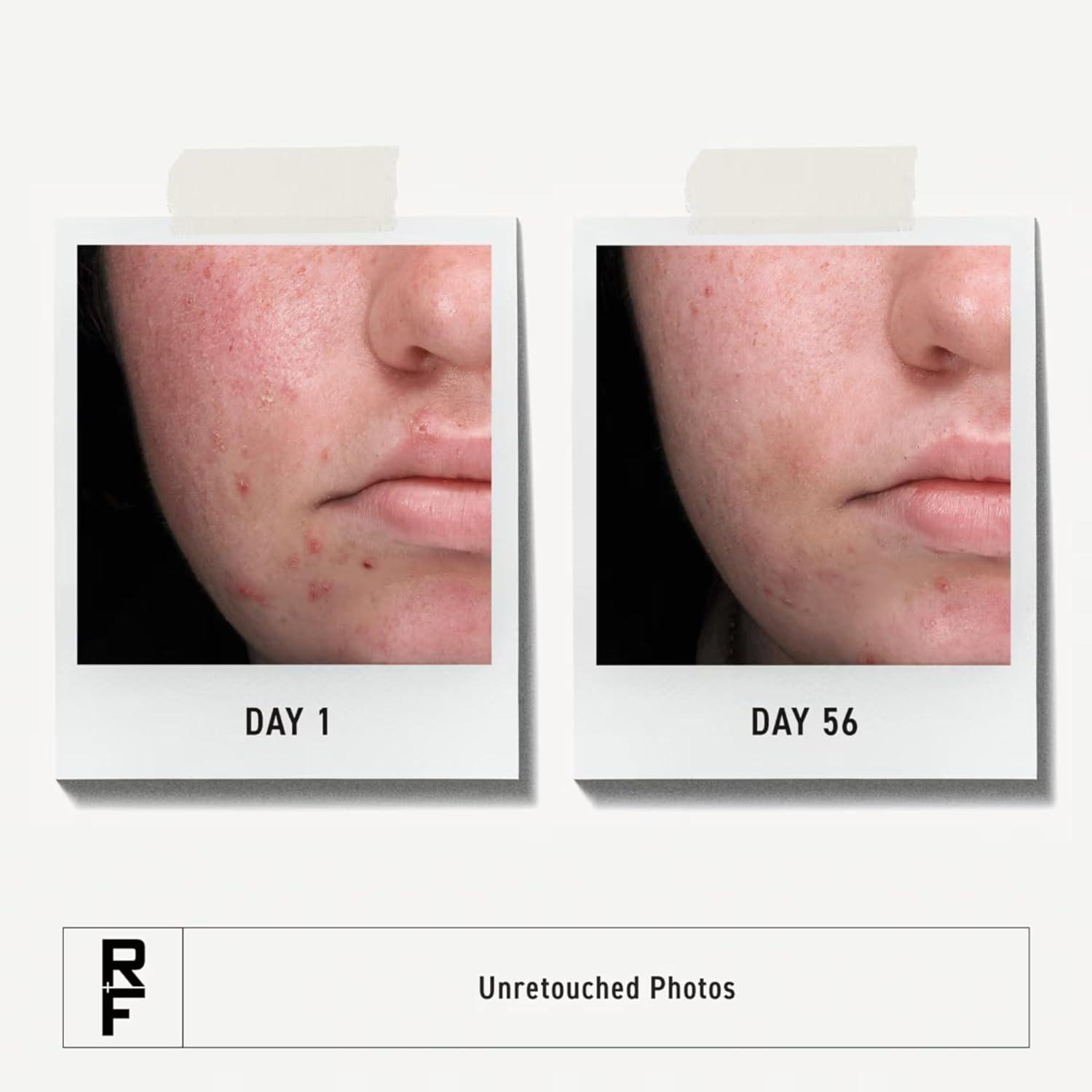 Rodan + Fields Spotless Review: Dose It Clear Acne?