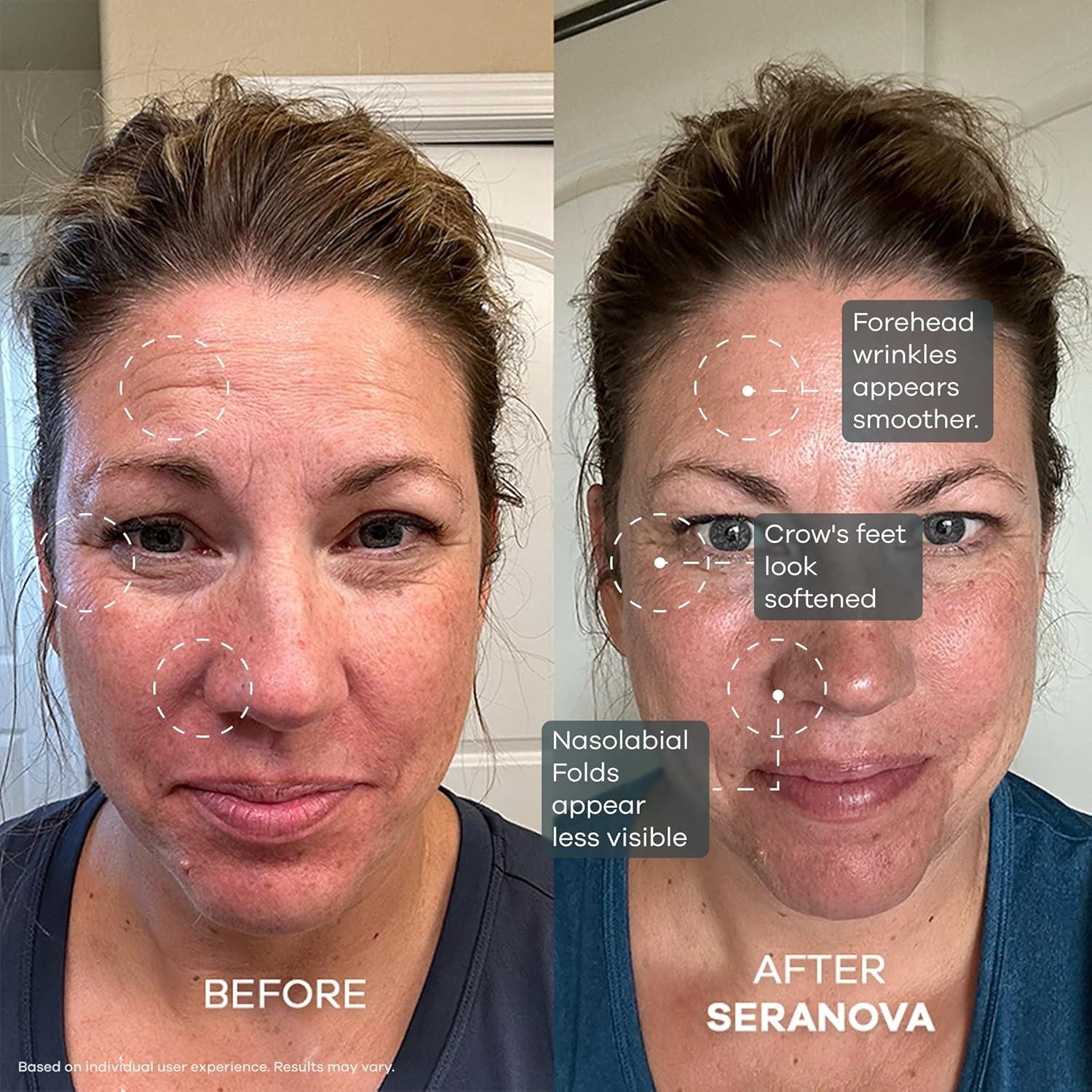 Seranova Micro Infusion Review: Does It really Work?