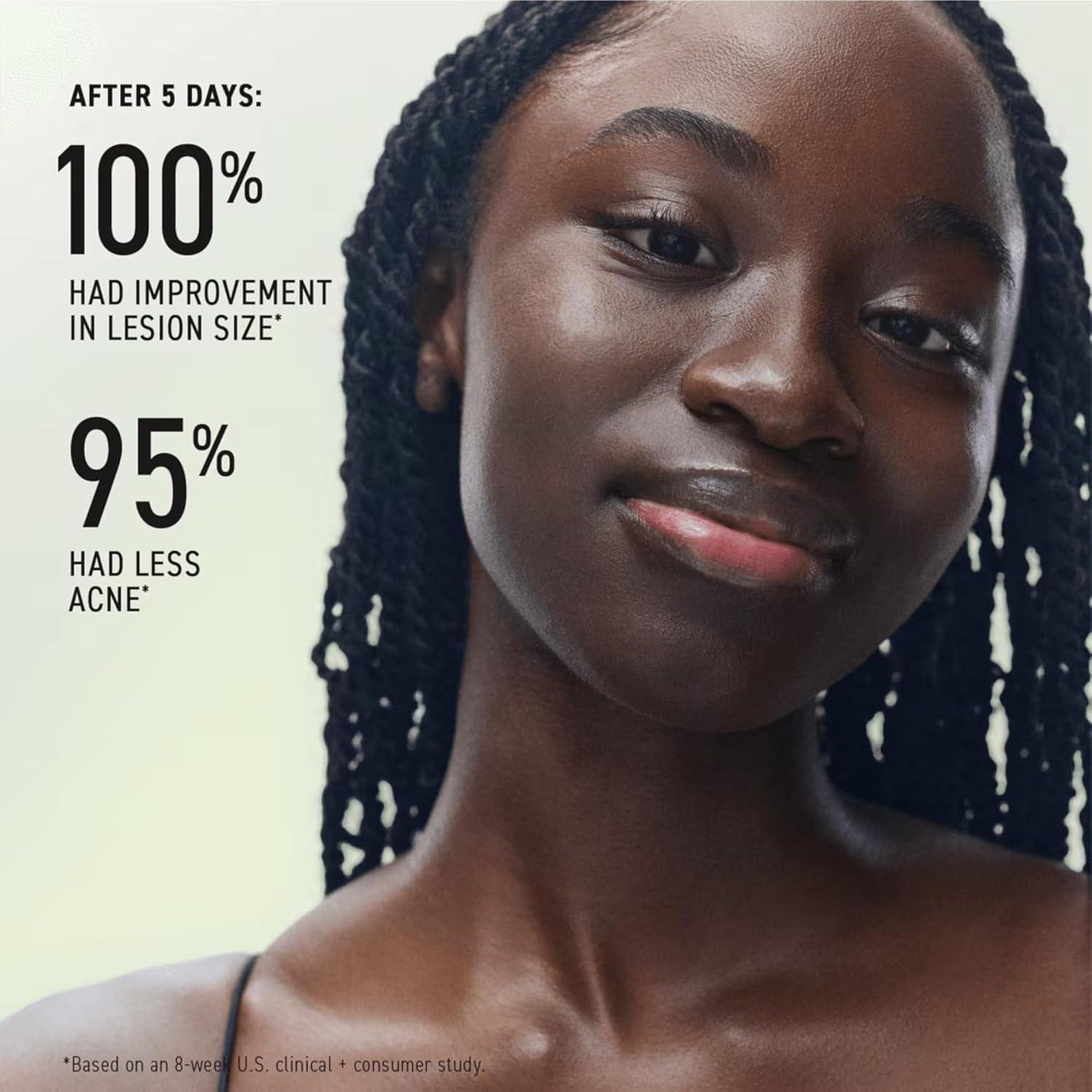 Rodan + Fields Spotless Review: Does It Clear Acne?