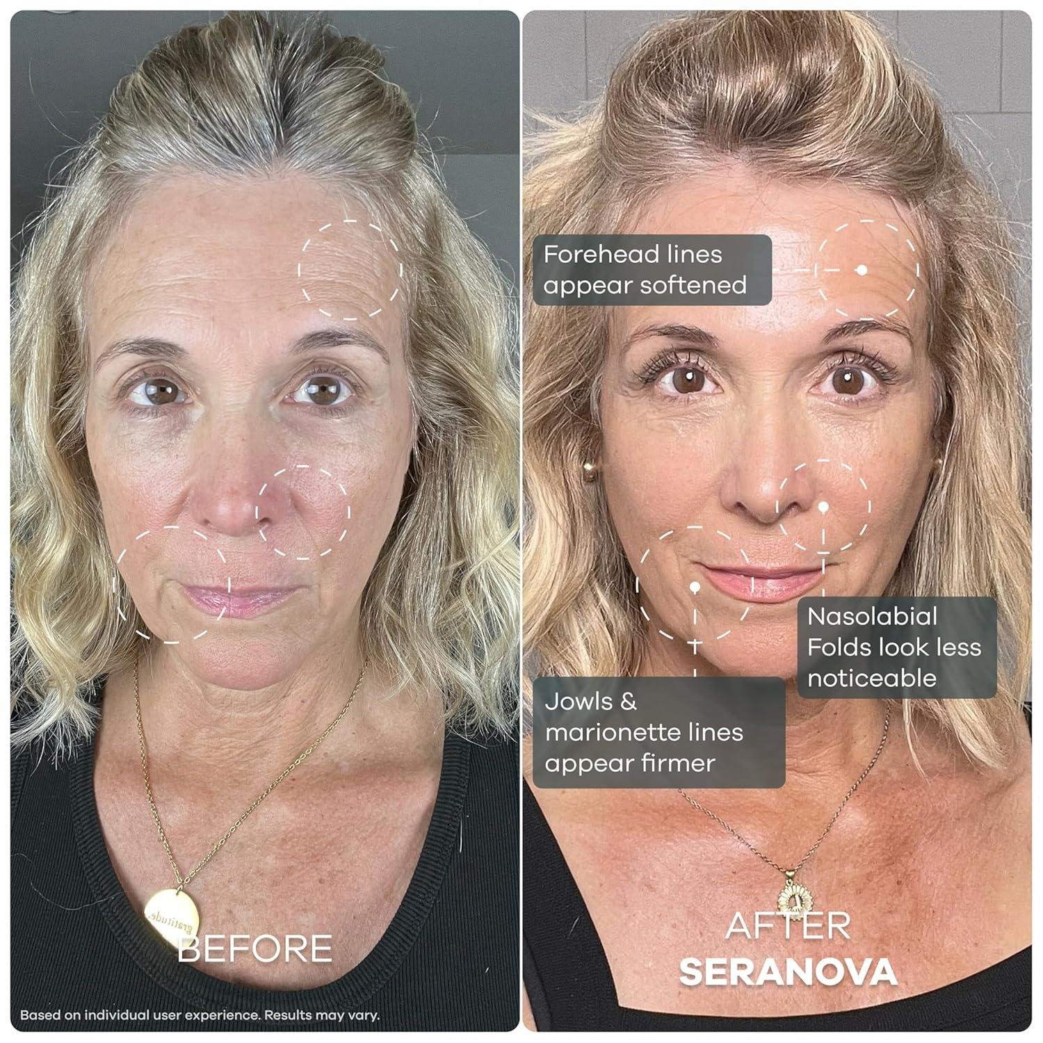 Seranova Micro Infusion Review: does It Really work?