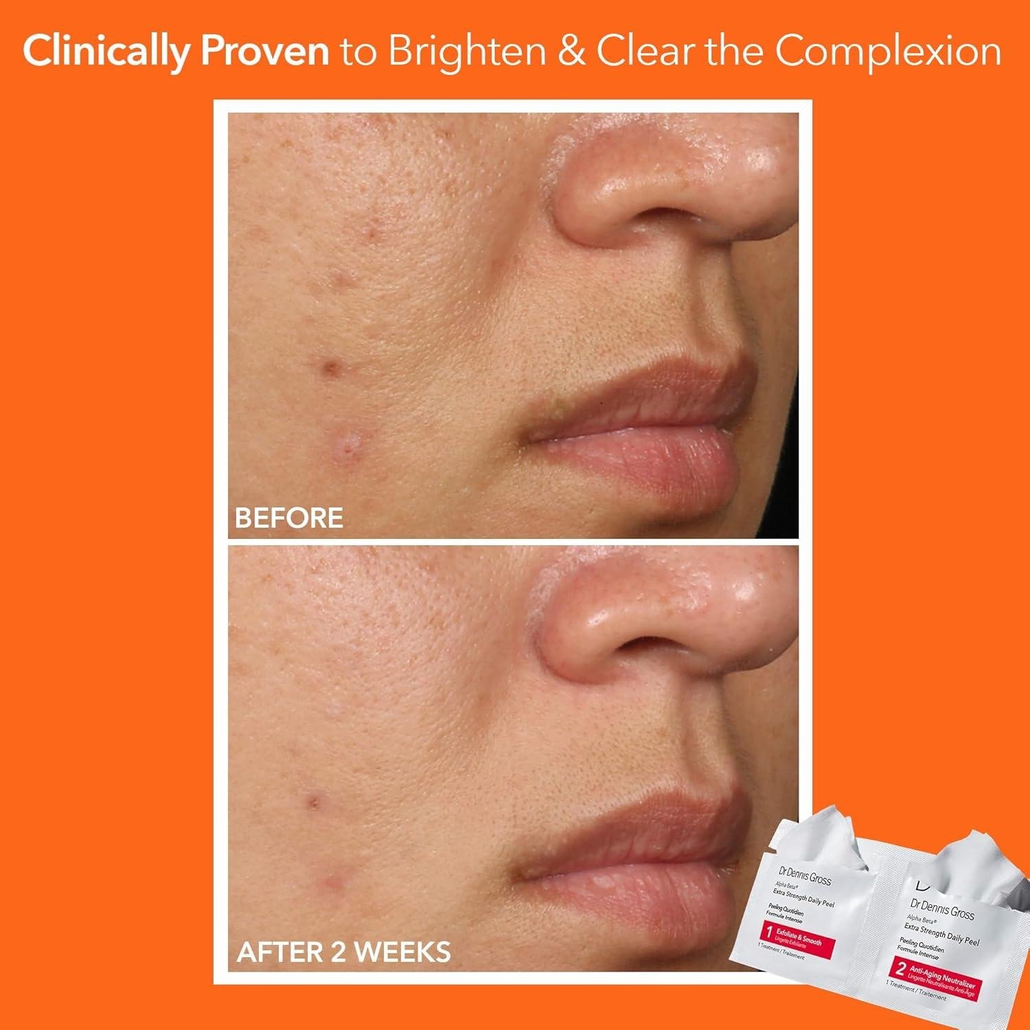 Dr. Dennis Gross Peel Review: Worth It for Aging Skin?